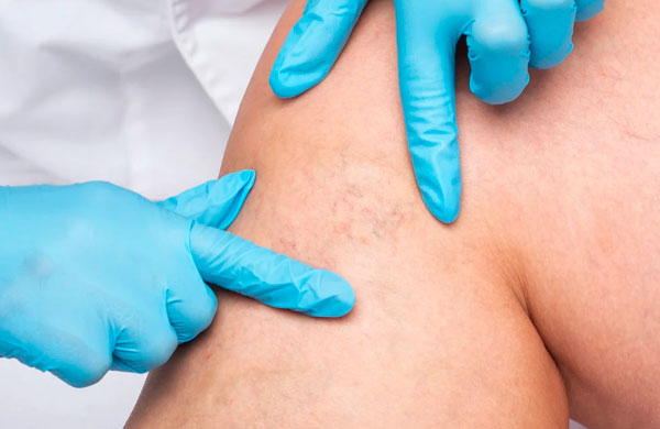 Curso de Procedimento Estético Injetável para Microvasos (PEIM)