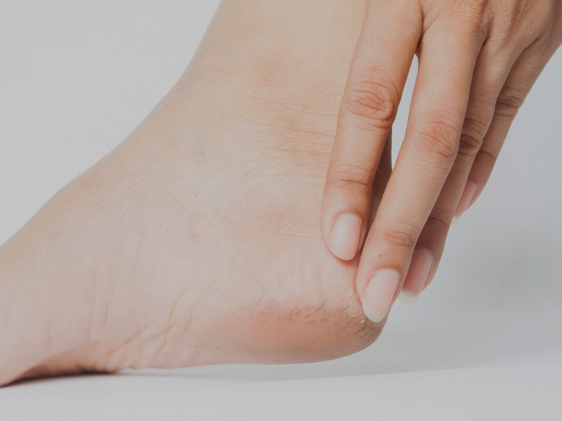 O que faz um podólogo -Tratamento de fissuras e ressecamento