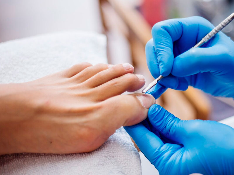 O que faz um podólogo - Unhas encravadas (onicocriptose)