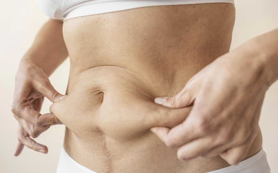 Estética pós-emagrecimento - O que a perda rápida de peso provoca na pele e no corpo? 
